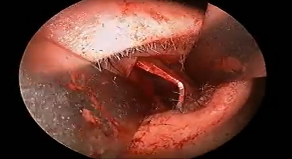 Nose Septal deviation cartilage exposed