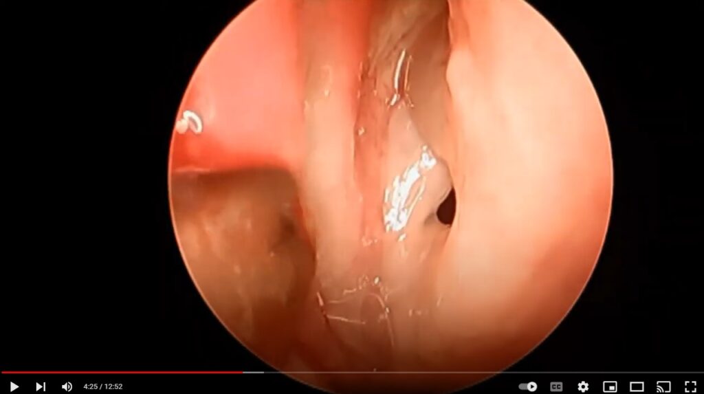 hybrid sinus surgery