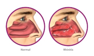 rhinitis